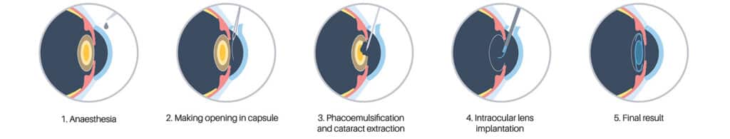 Chart illustrating the cataract surgery process